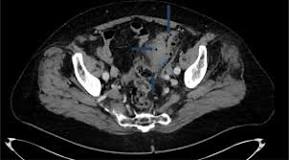 Image result for icd 10 code for peridiverticular abscess