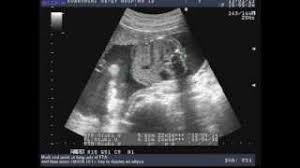 Mit einer größe von ungefähr 30 cm und einem gewicht von rund 550 g ist dein baby in nächster zeit besonders agil. 24 Ssw Das Baby Im Bauch Entwicklung Grosse Gewicht