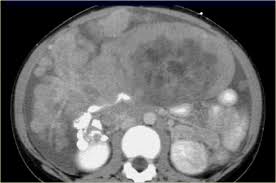 We did not find results for: The Radiology Assistant Peritoneal Pathology