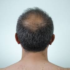 To prevent hair loss, people may want to try: How To Fight Male Pattern Baldness