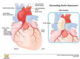 Thoracic Aortic Aneurysm Michigan Medicine Some aortic aneurysms burst, some don't.