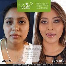 Una dintre interventiile moderne de la nivelul fetei, bichectomia, este trucul la care apeleaza din ce in ce mai multe vedete internationale cat si autohtone. Redux Clinica Procedimiento Bichectomia Anestesia Local Recuperacion 4 5 Dias Resultados En 1 Mes Duracion Permanente Profesional Cirujano Tiempo Que Se Realiza 30 Minutos Proceso Incision En El Interior De Las Mejillas
