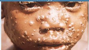 Today, monkeypox is considered the most important. Monkeypox Nurses Zone Source Of Resources For Nurses