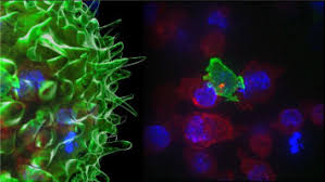 It may lead to greater than usual production of stem cells which then matures into any of the kinds of as the number of particular blood cells increases, cancer gets worse and results in the formation of tumours. Brain Cancer Potentially Resists Immunotherapies By Trapping T Cells In Bone Marrow Ecancer