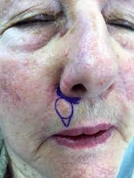 Dr Olivia Stevenson : Dermatology