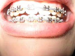 The dentist will advise how often the braces will need. 43 Braces Pictures Ideas Braces Teeth Braces Dental Braces