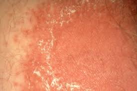 Image result for penis mycosis symptoms
