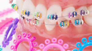 Ignore the online chatter that tries to tempt you into making your own braces. The Ultimate Braces Style Guide Braces Style And Color
