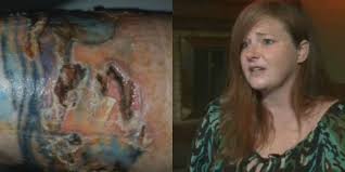You may already be aware that lasers are also used to remove tattoos. Local Woman Suffers 3rd Degree Burns From Laser Hair Removal