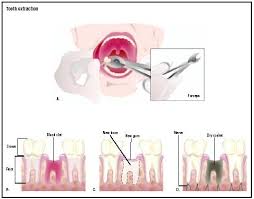 Tooth Extraction Procedure Blood Removal Pain Complications Infection Medication Heart