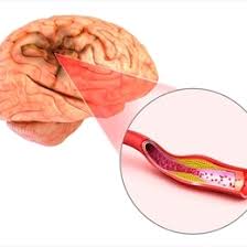 Lenfomada, lenf nodlarında, lenf damarlarında ve vücudun diğer organlarında anormal sayıda lenfosit meydana gelir. Iskemi Nedir Ve Belirtileri Nelerdir Medicana