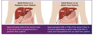 Due to the liver's unique ability to regenerate, the partial livers of both the donor and recipient soon grow into complete organs. Living Donor Liver Transplant Uw Medicine