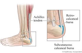 Dalam beberapa kasus, gejala ini disertai dengan rasa sakit dan perubahan warna pada kulit. Calcaneal Bursitis