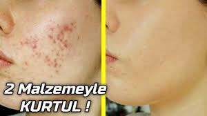 En Keskin Sivilce Yok Edici Cilt Maskesi Guzellik Bakim Youtube