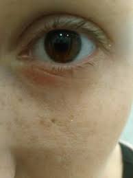 Neurodermitis Oder Nur Trockene Haut Augen Medizin Dermatologie