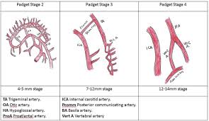Image result for Posterior Circulation