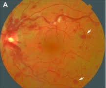 Image result for Acute Vision Loss