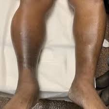 Image result for Lipodermatosclerosis