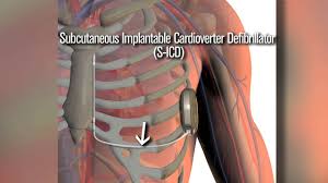 Image result for Internal Cardiac Defibrillator