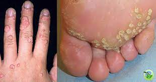 Hpv atau human papilloma virus merupakan satu golongan virus yang berisi kurang lebih 150 jenis virus. Uncategorized Page 2 Pusat Imunisasi