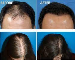 ✔ professionally formulated hair regrowth product with 5% minoxidil, retinoic acid (tretinoin), azelaic acid, abntm complex, and caffeine. Hair Loss Treatment Skin Iowa Cosmetology Dermatology Des Moines