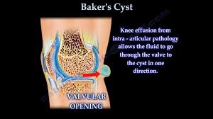The best knee bursitis treatment is bfst. Baker S Cyst Physiopedia