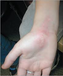 Convexity defects returns an array where each row contains these values Photoclinic Herpes Simplex Virus Infection Consultant360