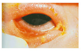 Image result for Gonococcal Conjunctivitis