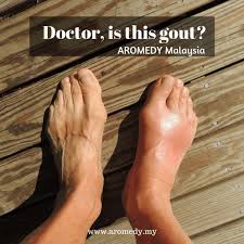 Minyak alpukat atau minyak kelapa? Cara Hilangkan Gout Kaki Dan Kurangkan Asid Urik Aromedy