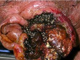 Surface skin miases (myasis cutis syperficialis) are caused most often by the larvae of blue meat flies (sem. Myiasis Due To C Hominivorax In A B Lymphoma Patient Shown Is A Download Scientific Diagram