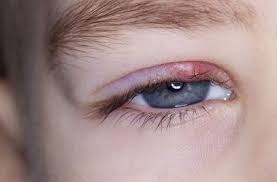 Als gerstenkorn (hordeolum) wird eine schwellung am augenlid bezeichnet, die akut und plötzlich welche ursachen ein gerstenkorn hat, was gegen die entzündung hilft und wie lange es dauert bis. Wie Sie Ein Gerstenkorn Loswerden Behandlung Und Heilmittel Bei Gerstenkornern