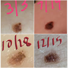 Melanoma melanoma is the least common but the most deadly type of skin cancer. Incase Someone Wants To Know What Melanoma Can Look Like Melanoma