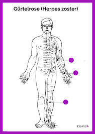 Gürtelrose oder herpes zoster äußert sich durch schmerzhaften, bläschenbildenden hautausschlag entlang der gürtelrose oder herpes zoster ist eine virusinfektion, die mit einem schmerzhaften. Meridiane Im Korper Gurtelrose Herpes Zoster Zisano