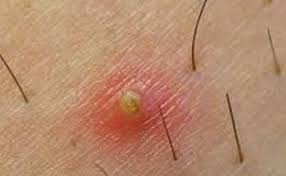Infected Underarm Cyst Ingrownhairchin Ingrownhairpreventing Ingrown Hair Treatment Infected Ingrown Hair Ingrown Hair Remedies