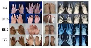 Image result for Syndactyly