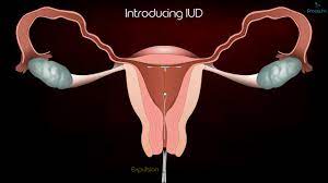 Ouidah, or whydah, a port city in benin. Intrauterine Device Iud Copper T Removal Procedure Patient Education Medical Animation Youtube
