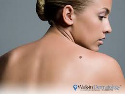 Skin cancer is the most common type of cancer in the united states by a pretty large margin, and it does not discriminate. How To Deal With A Pimple Within A Mole Walk In Dermatology