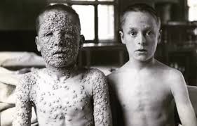 Chiedono l'iniezione sulla cicatrice del vaccino per il vaiolo Vaccino E Vaiolo Due Storie In Una Missione Scienza