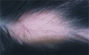 You are still a teenager.normally hair growth occurs after 16yrs of age. Alopecia Areata A Review Sciencedirect