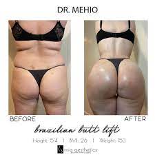 Mia aesthetics 6929 airport blvd ste 103. Mia Aesthetics This Transformation Bbl By Dr Mehio Facebook