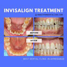 This 50 Years Old Female Patient Is Treated With Invisalign Severe Irregularity Is Corrected Successfully Invisali Invisalign Teeth Alignment Dental Clinic