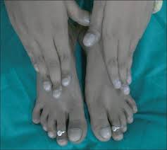 Image result for Clubbing nails feet