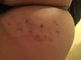 Apply ice immediately after the injury. Bruising On Butt Pictures October 2020 Babies Forums What To Expect