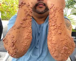 Xanthoma - Causes - Diagnosis - Best treatment Option | Homeopathic | Best Homeopathic Doctor in Pakistan | Dr Qaisar Ahmed MD, DHMS