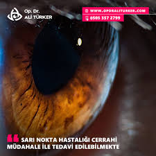 Yasa Bagli Makula Dejenerasyonu Sari Nokta Hastaligi Gozumuzun Gorme Sinirlerinin Bulundugu Retina Tabakasinda Olusan Bir Hastalik Doktorlar Isaretler Gozler