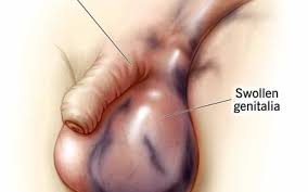 Image result for paraphimosis