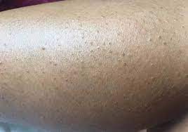 Ingrown hair treatment for legs. Ingrown Leg Hair Infected Removal Treatments Strong Hair