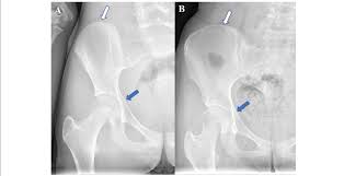 Image result for Risser Sign