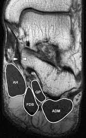 Magnetic resonance imaging (mri) is the modality of choice in diagnosing accessory muscles, delineating their relationship to adjacent structures, and differentiating them from soft tissue tumors. Radiologyer Mri Foot Muscles