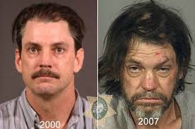 But if you have inherited male or female pattern baldness, arthritis medications could trigger or accelerate such permanent hair loss. This Is What Heroin Does To Your Face Shocking Images Show Ravages Of Drug Use World News Mirror Online